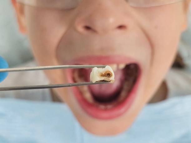 Best Emergency Tooth Extraction in Chesapeake Beach, MD